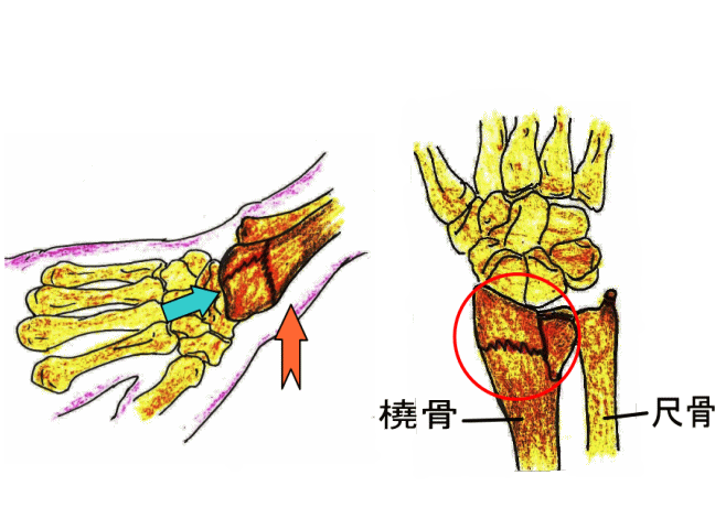 橈骨遠位端骨折とは・・・