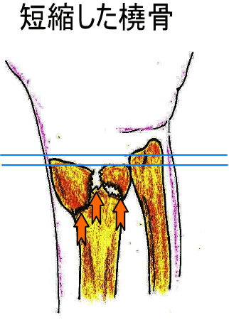 短縮した場合の治療法は・・・